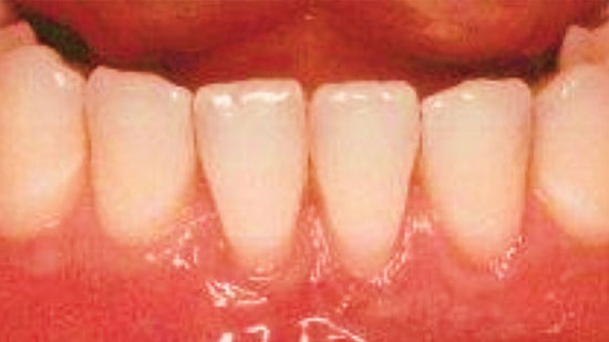 bonjela receding gums