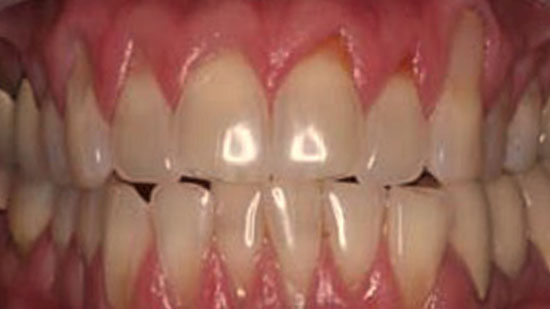 Gum Recession - Fort Lauderdale, FL - Periodontist