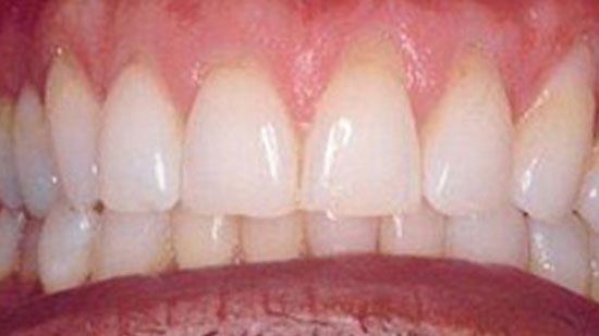 Gum Recession - Fort Lauderdale, FL - Periodontist