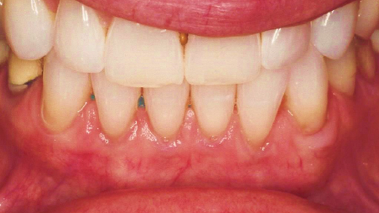 Gum Recession - Fort Lauderdale, FL - Periodontist