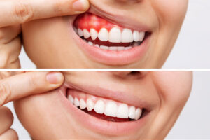 Two shots of a young woman with red bleeding gums and health gums, before and after treatment isolated on a white background.