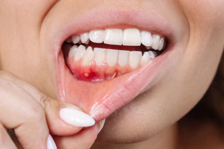 Close up of a ulcerative stomatitis on the gums. Gum inflammation. Cropped shot of a young woman showing red bleeding gingiva with an ulcer. Dentistry, dental care concept.