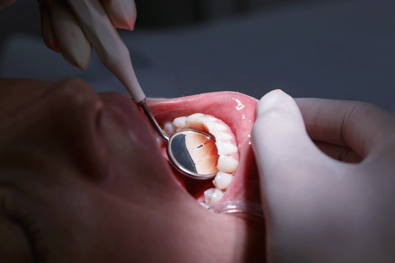 Patient at dentists office, getting her white teeth interdental spaces examined with hand-held mirror for tartar and plaque.